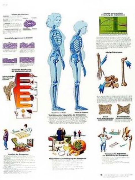Afbeeldingen van Osteoporose